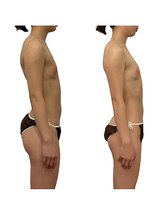 ベンザイ 梅田店(BENZAI)/肩こり、反り腰、姿勢改善