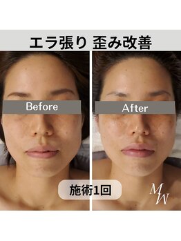 ミピマム/歪みとエラ張りを同時に解消