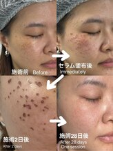 みや美/《ホワイトラボ》施術経過♪