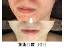 ハーブピーリング&毛穴洗浄専門店 肌REVO 高田馬場店[ニキビ/毛穴/たるみ/美白/シミ]/ハーブピーリング/ニキビケア