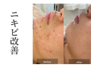 エトレ(etre)/月1サロンケアとホームケア/毛穴