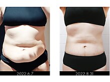 ラグラン銀座メディカルエステ 高輪ゲートウェイ店/【BODY】セルマジ・ビフォアフ