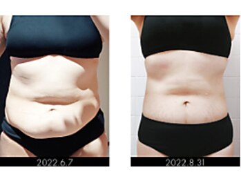 ラグラン銀座メディカルエステ 高輪ゲートウェイ店/【BODY】セルマジ・ビフォアフ