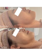 ルシェリア(Le cherien)/ハーブピーリングで小顔効果も！