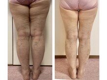 ボディアーキ 高知大丸店(BODY ARCHI)/足のbefore・after