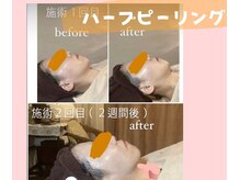 ダイダイ(daidai)/ハーブピーリング