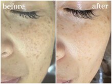 ホワイトアクア 天王寺本店(WHITE AQUA)/ララピールでシミケア！天王寺