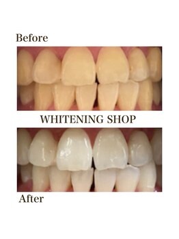 ホワイトニングショップ あおもり新町店/輝く歯 印象up Before After