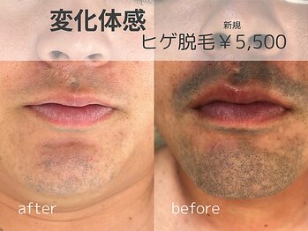 リモア(REMORE)/圧倒的な脱毛効果！