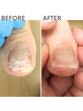 クオッカ(Quokka)/割れ爪・欠け爪修復