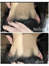 チル(chill)/うなじ脱毛