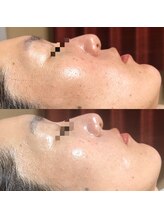 エステサロン マコ(MaCo)/40代・毛穴の開き改善