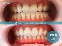セルフホワイトニング専門店 シマエナ上新庄駅前店/1回でワントーン白く