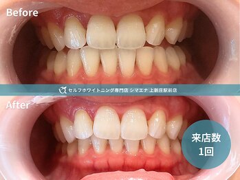 セルフホワイトニング専門店 シマエナ上新庄駅前店/1回でワントーン白く