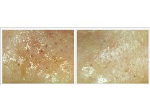 サロン ド ボーテ プルーラ(Salon de beaute PLURA)/ベタベタ毛穴もキレイに☆