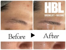 ルース(LUZ)/HBL+メンズ肌質改善エステ