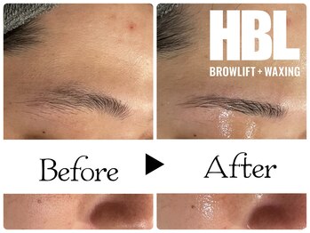 ルース(LUZ)/HBL+メンズ肌質改善エステ