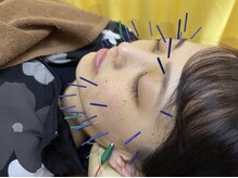 まつもと鍼灸接骨院 つくば/美容鍼もお試しください。