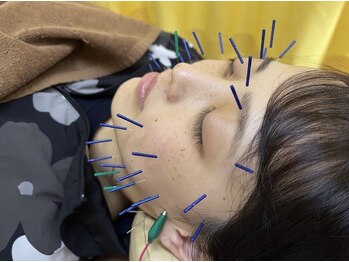 まつもと鍼灸接骨院 つくば/美容鍼もお試しください。