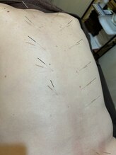 鍼灸ハウス(鍼灸house)/