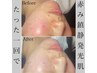 【ご新規様人気No.2】とにかくお肌に透明感!赤み.ニキビケア¥13750→¥8800