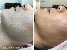 ゴールドプラス 半田店(GOLD PLUS)/BeforeAfter