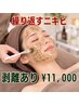 【剥離あり】ニキビ・跡ケアに！徹底肌質改善オーガニックハーブピーリング