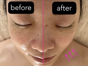 癒庵/バザルトフェイシャル