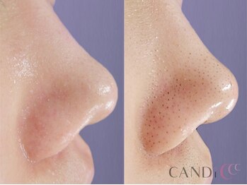 キャンディ 大阪梅田店(CANDi)/ハイドラピーリング/黒ずみ毛穴