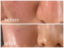 ルー ハナレ 神戸岡本 摂津本山店(Luu HANARE)/1年小顔毛穴改善・シミ改善