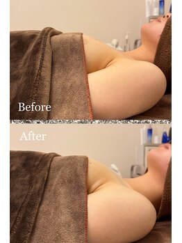 プリマベラ 大阪梅田(primabella)/巻肩改善！