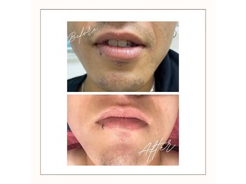 ラベニール(La Benir)/ひげ脱毛