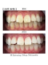 ホワイトニングショップ 静岡店/ホワイトニングBefore→After