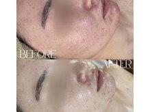 《ハーブピーリング変化》1回でも実感