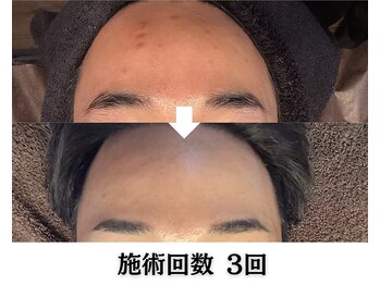 ハーブピーリング&毛穴洗浄専門店 肌REVO 高田馬場店[ニキビ/毛穴/たるみ/美白/シミ]/ハーブピーリング/ニキビケア