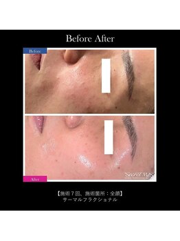 リアンの写真/【肌悩み特化】肌トラブルからエイジングケアまで何でも対応◎最新マシンで土台から整え憧れのツヤ美肌に♪