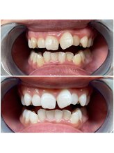 ライトケアサロン 表参道店(Light Care Salon)/セルフホワイトニング