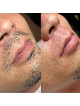 エピシアドットエヌ(epicia.N)/ワックス1日で口元スッキリ