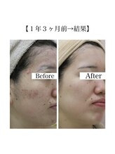 スマートポッシュ(Smart posh)/【ニキビケア】before→after