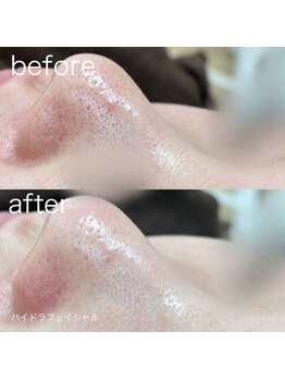 ルルラ リコ(lulula rico)/症例写真/ハイドラ毛穴洗浄