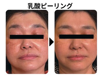 ラディアント たまプラーザ/乳酸ピーリング(スノーピール)