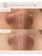 エンルーチェ プラスエイト(en;Luce+8)/ハイドロフェイシャル