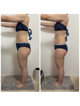 エステサロンブランシュ(Esthe salon Blanche)/ハイパーナイフ下半身痩せ