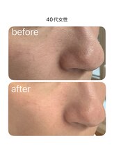 マーレ(Mare)/肌に負荷なく毛穴洗浄