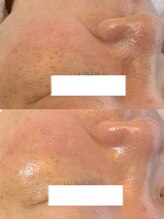 イルー(ILuu)/お客様ビフォーアフター