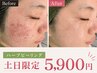 【盛岡店 土日限定】毛穴悩みに徹底アプローチ剥離なしハーブピーリング
