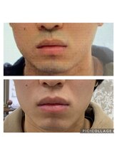 キングスサロン 長崎佐世保店(KING’S SALON)/☆髭専用☆プレミアム脱毛☆最強