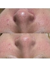 ハーナウ ハウ(hanau hou)/ハーブピーリング効果