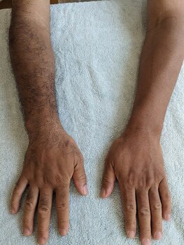 元気堂整体院/脱毛効果、院長が実感！