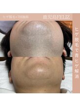 フェリス(FELIZ)/青ヒゲでお悩みの方必見